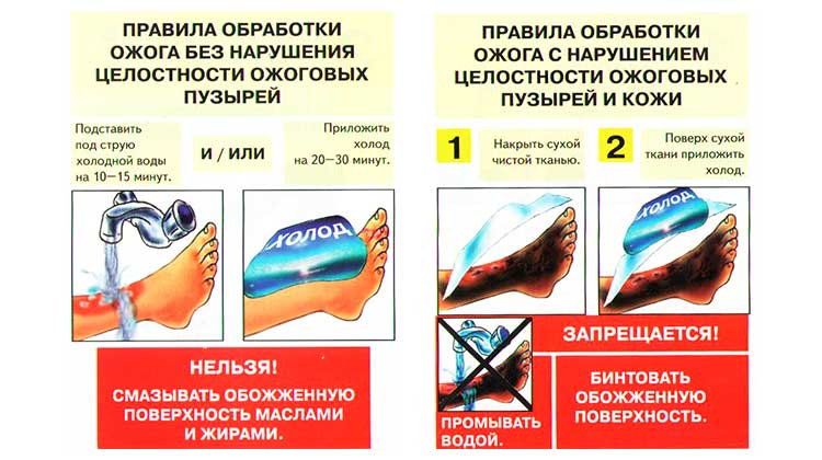 Первая помощь при ожогах